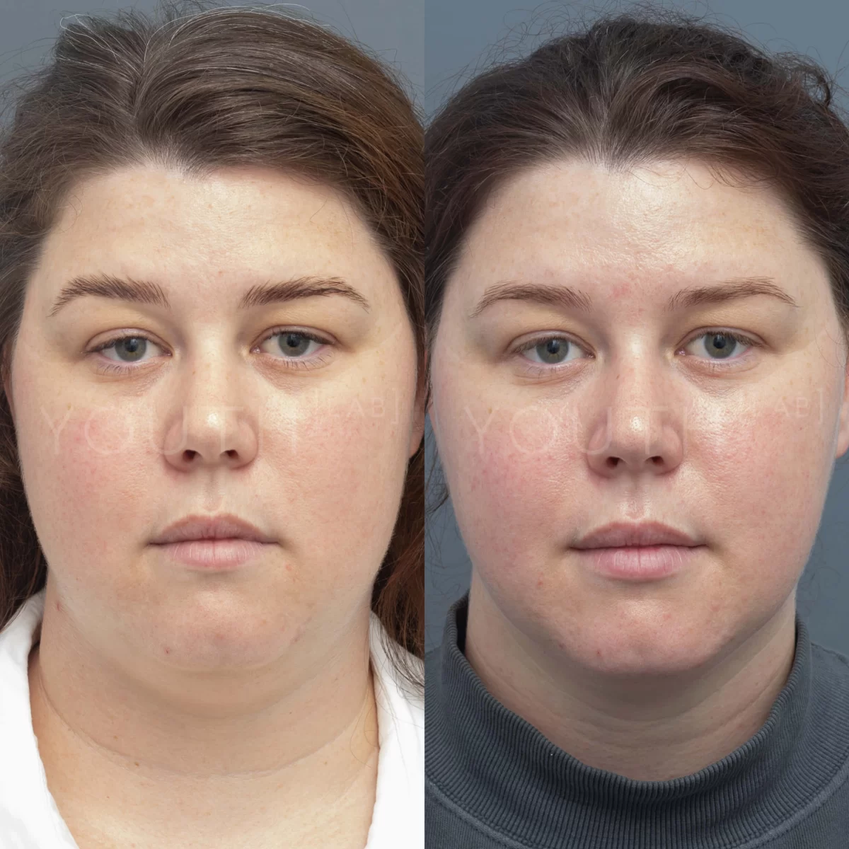Jawline slimming results