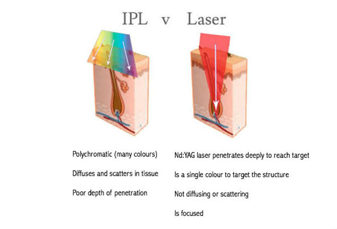 IPL vs Laser diagram