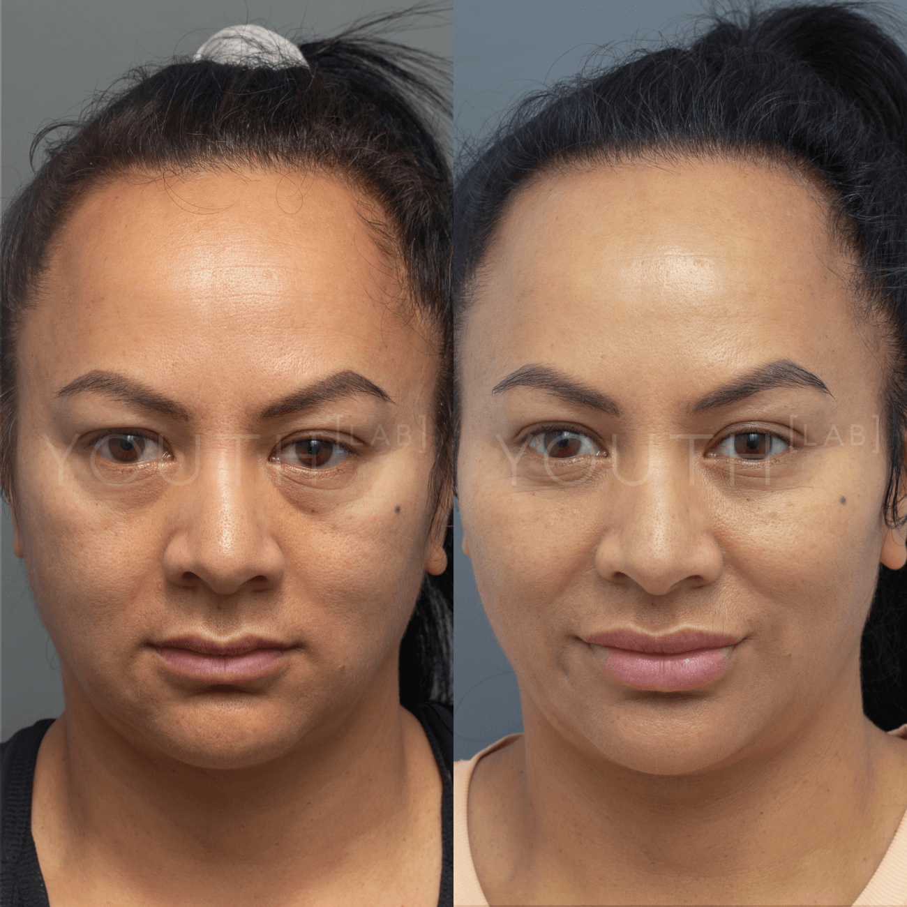 A dermal filler before and after by Nurse Danae 