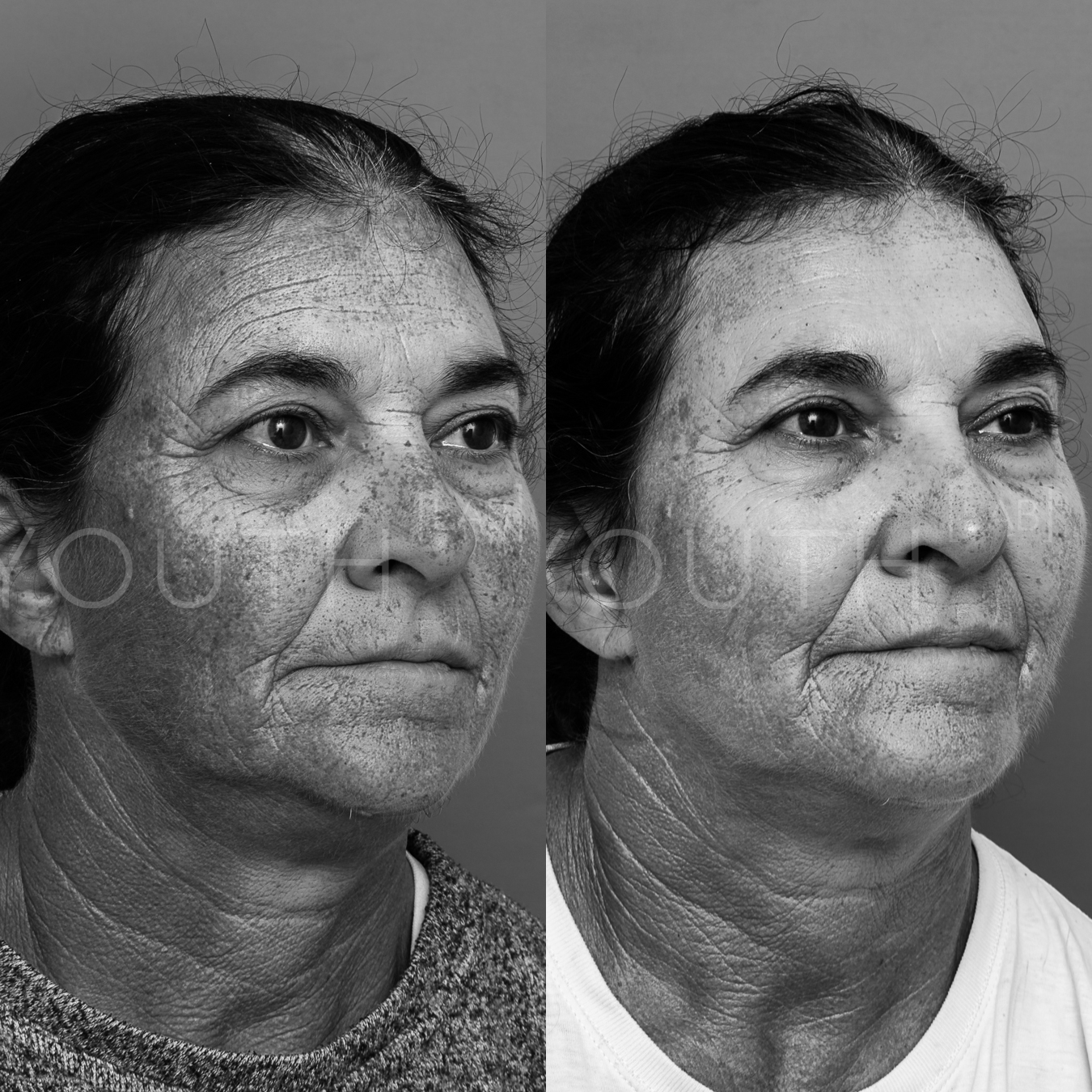 Before and after images of dermal pigmentation following a course of BBL treatment