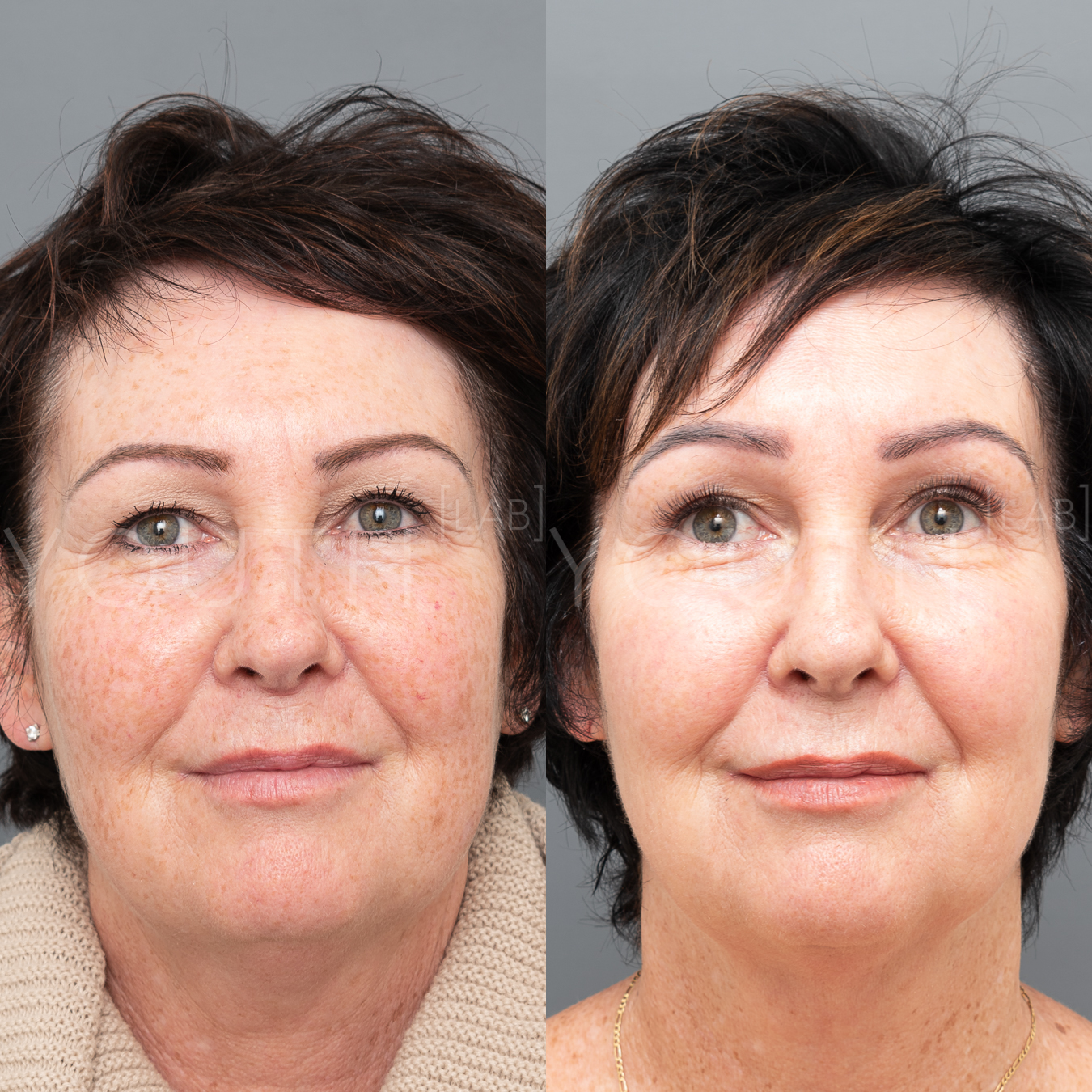 Before and after images following one session of BBL treatment