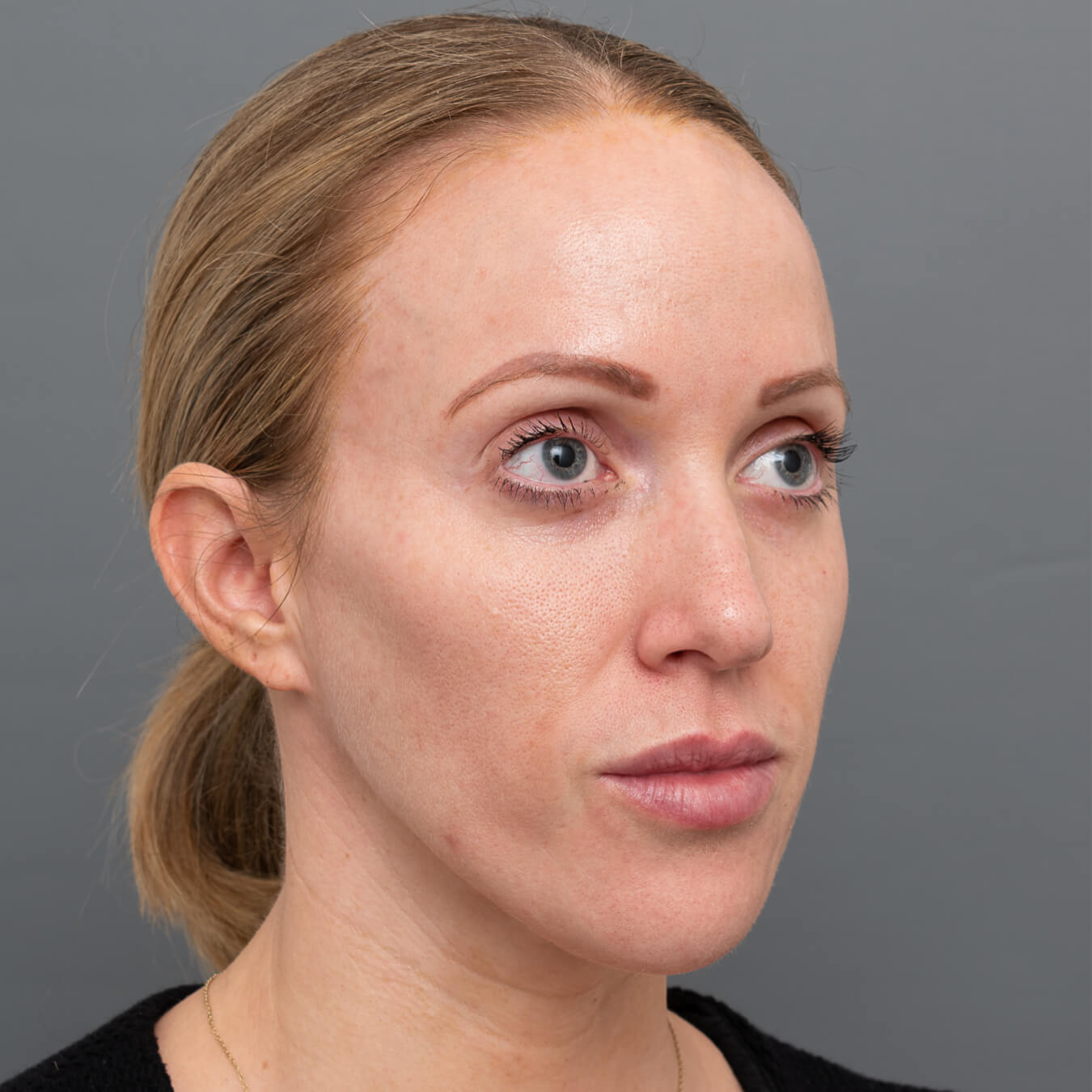 Dr. Kate Jameson portrait photo prior to Halo Treatment