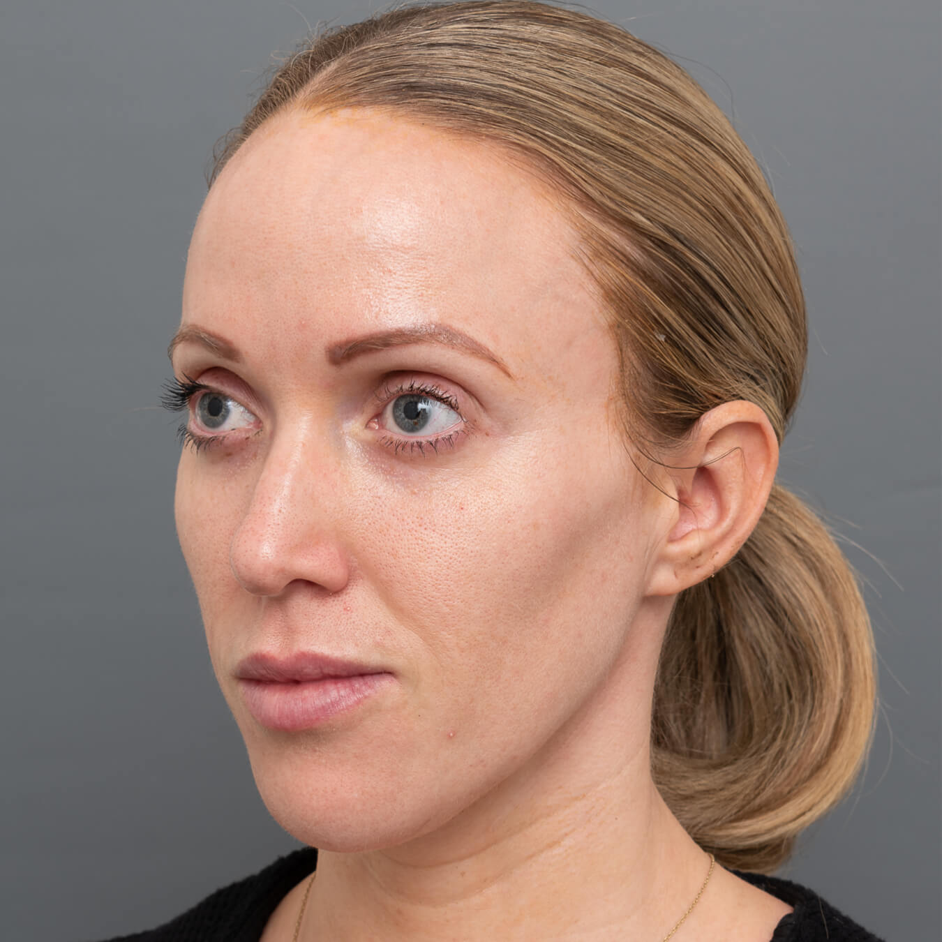 Dr. Kate Jameson portrait photo prior to Halo Treatment