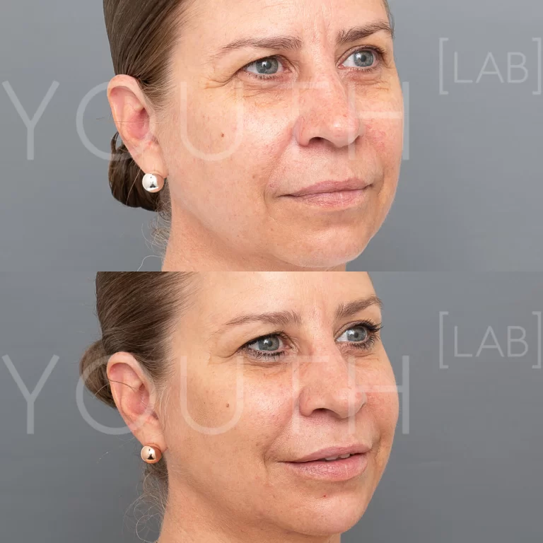 liquid face lift before and after 1