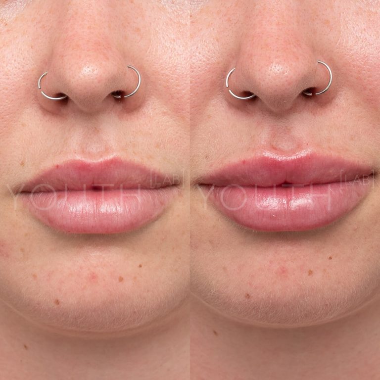 lip enhancement using lip filler before and after 2