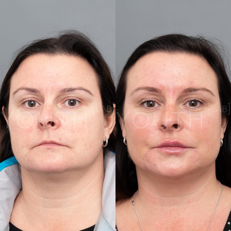 before and after with dermal fillers