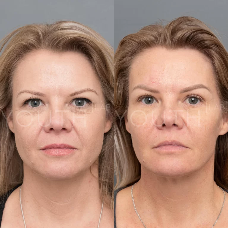 before and after with dermal fillers 2