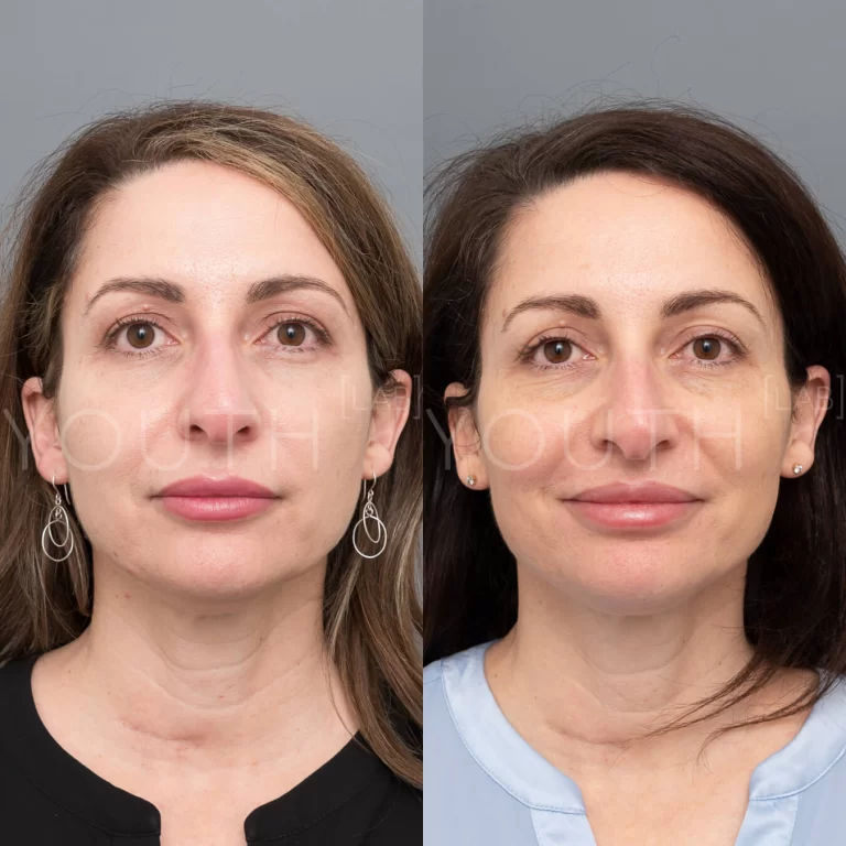 liquid face lift before and after 2