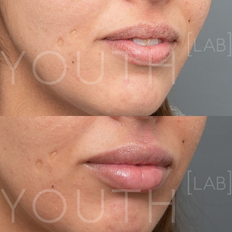 lip enhancement using lip filler before and after 1