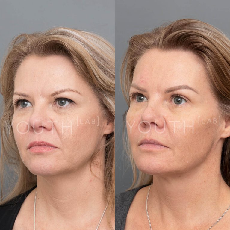 Cheek enhancement treatment before and after