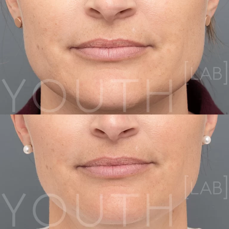 jawline slimming masseter reduction before and after 2