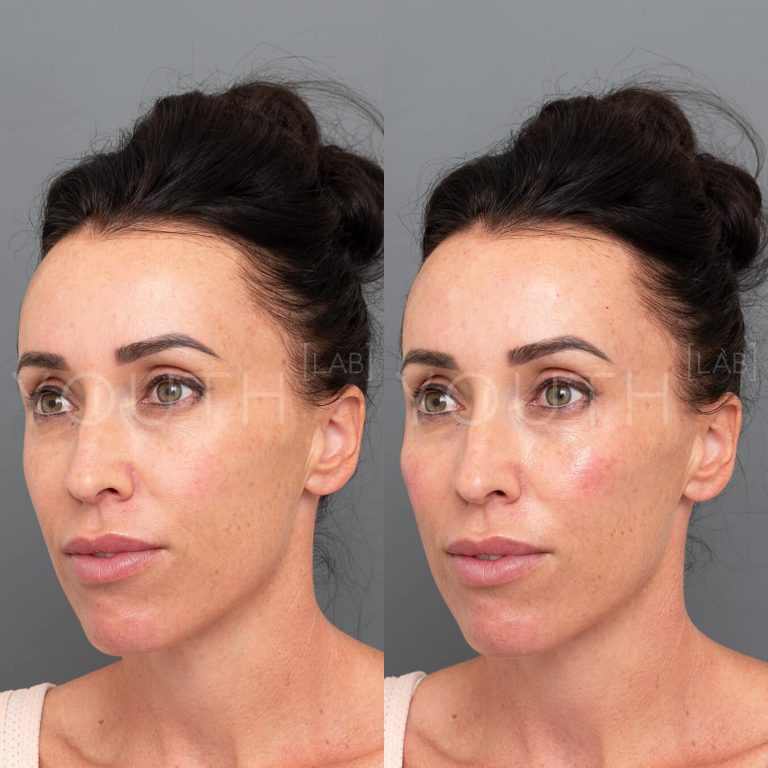 Cheek enhancement treatment before and after 2