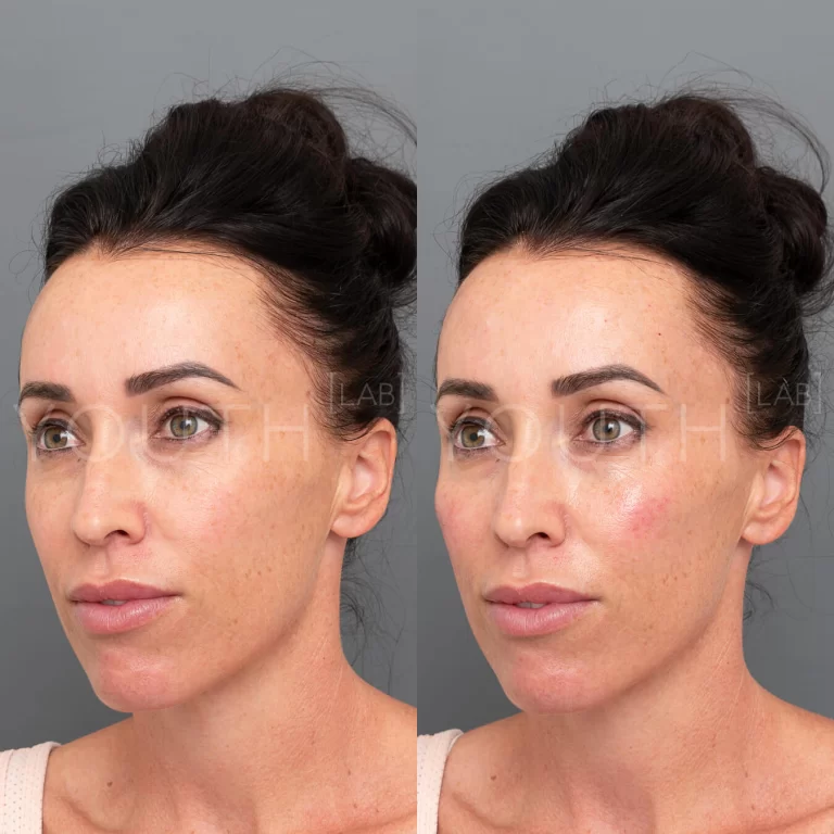 Cheek filler treatment before and after 2