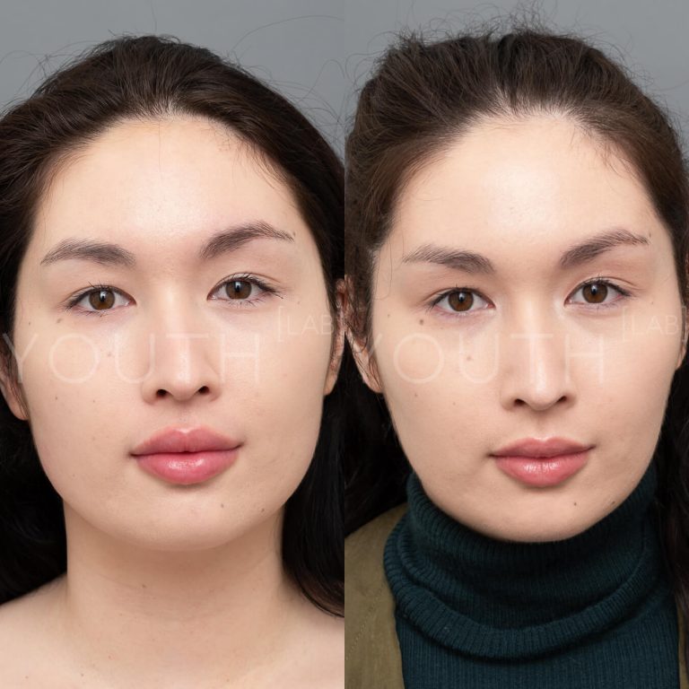 jawline slimming before and after 1