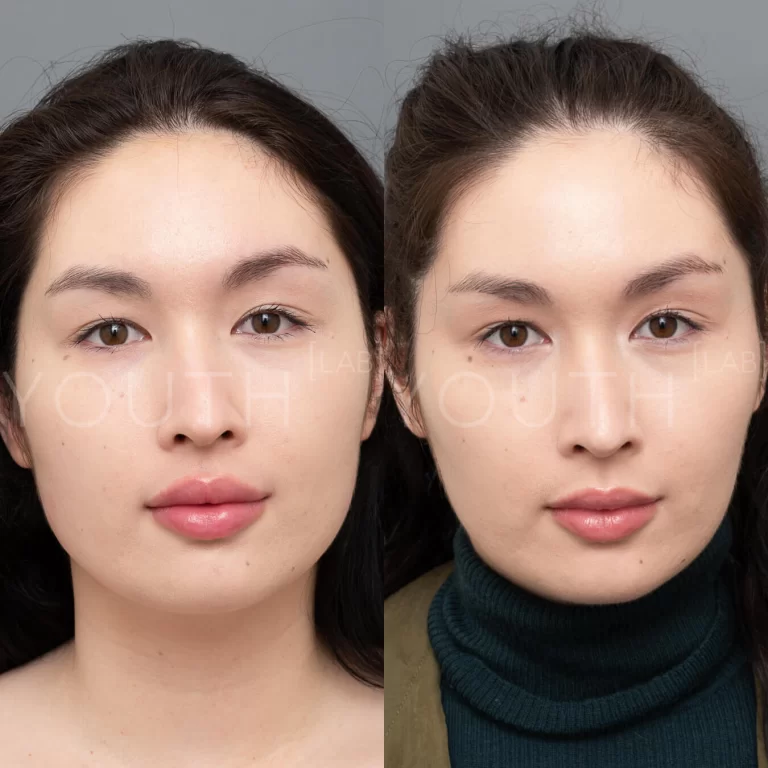 Jawline Slimming Injections