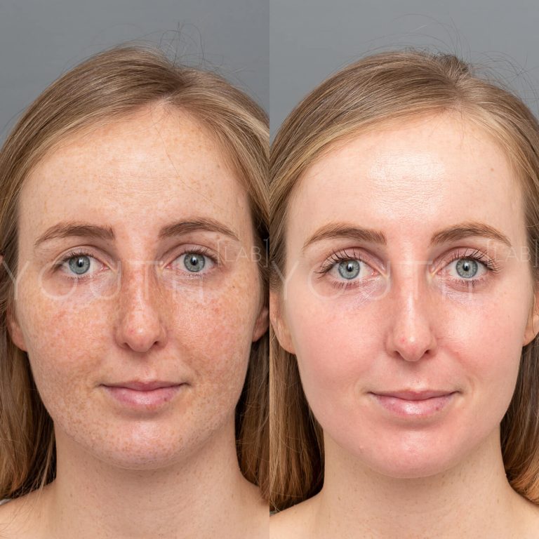 before and after Dermamelan Depigmentation peel front