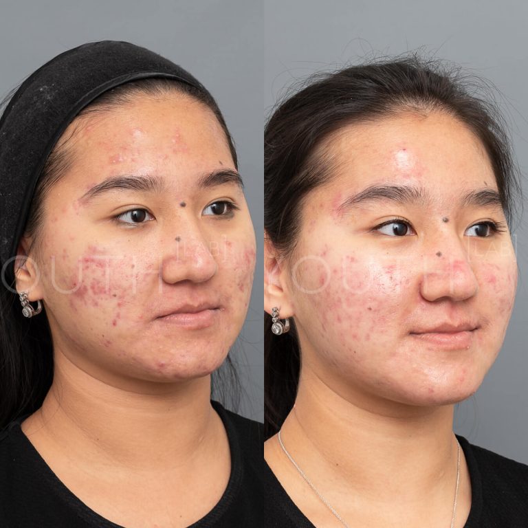 Acnelan peel by Mesoesthetic before and after