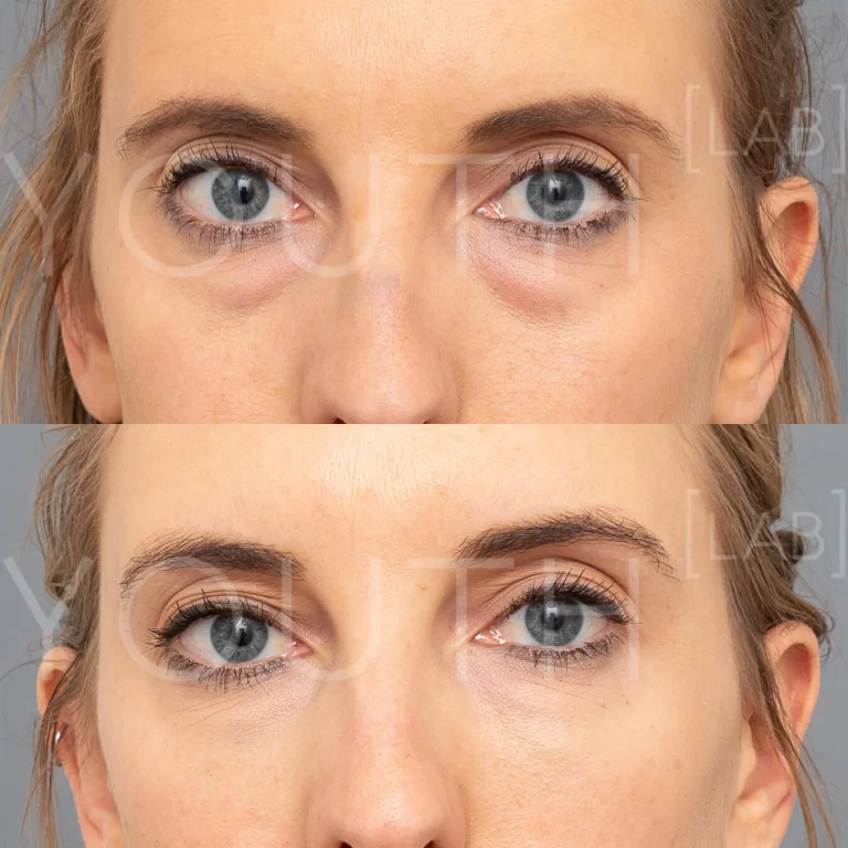 Eye bags and dark circles under eyes treatment: help reduce puffy eyes and  dark eyelids