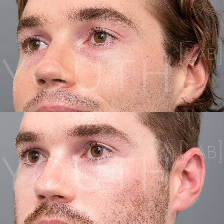 before and after of Plasma Therapy (PRP) - close up