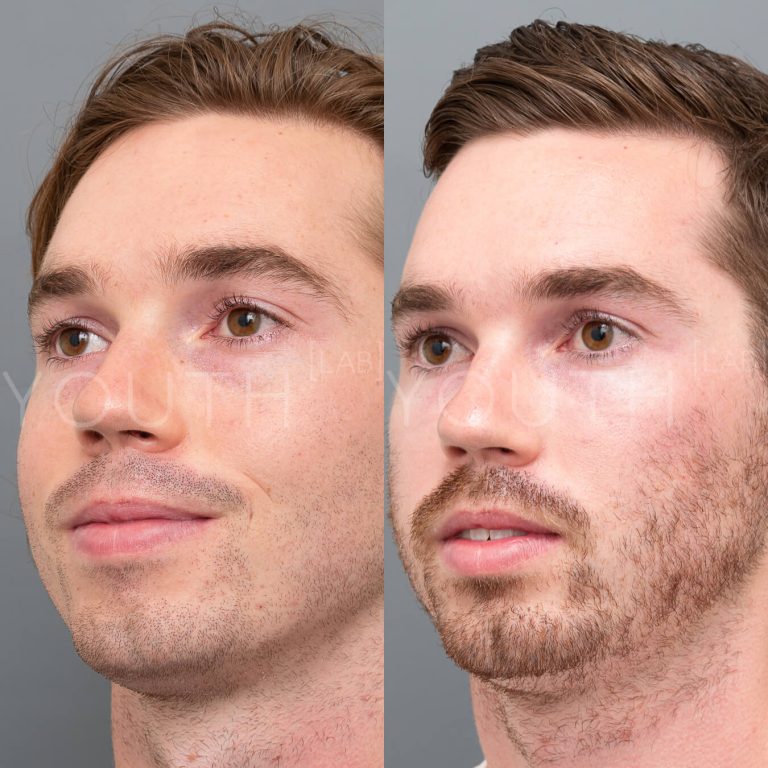 before and after of Plasma Therapy (PRP)