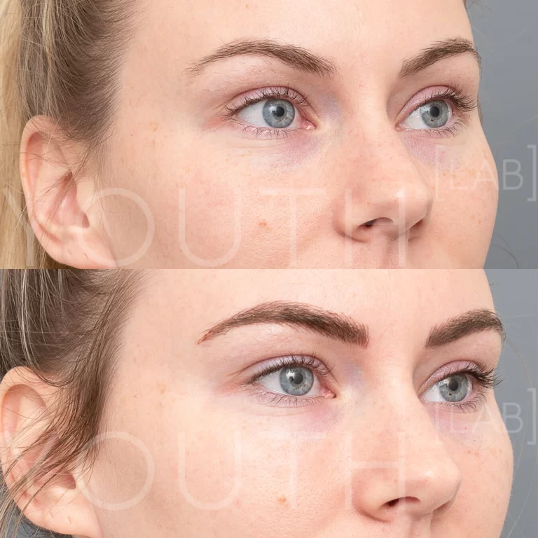 tear trough filler before and after