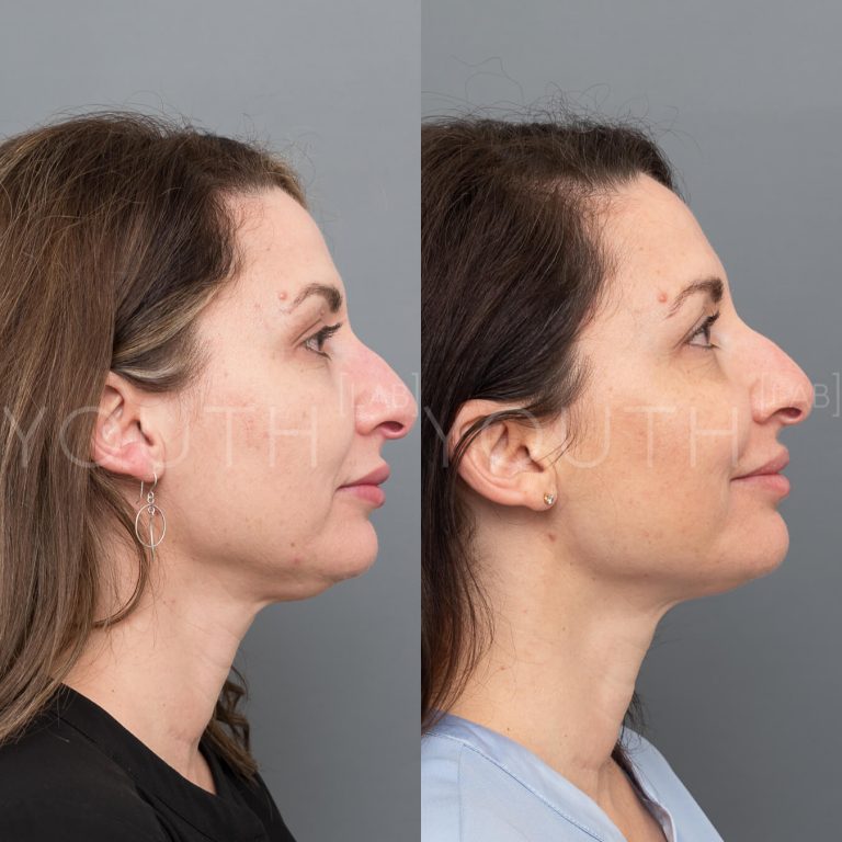 fat dissolving treatment before and after 1
