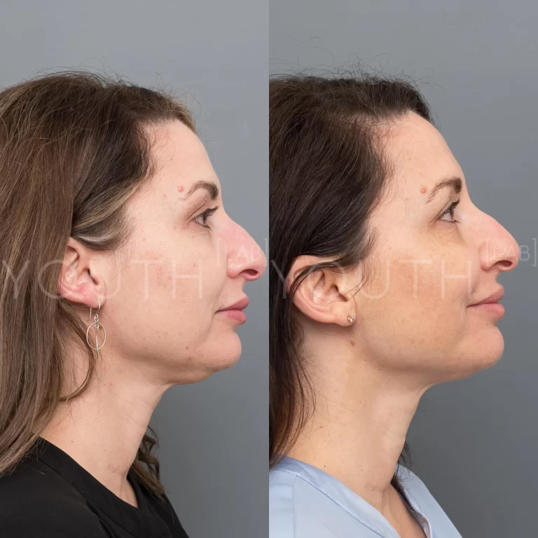 fat dissolving treatment before and after 1