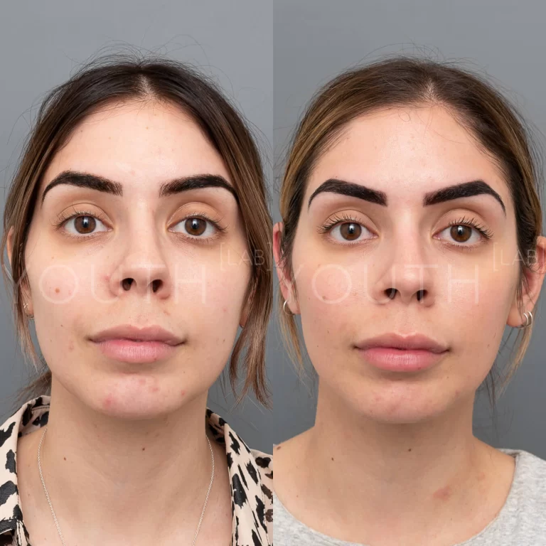 before and after hydrafacial treatment at Youth Lab