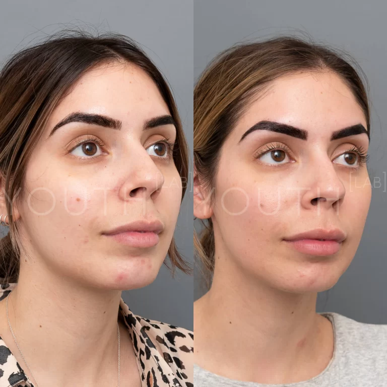before and after hydrafacial treatment