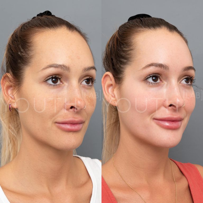 before and after Dermamelan Depigmentation peel