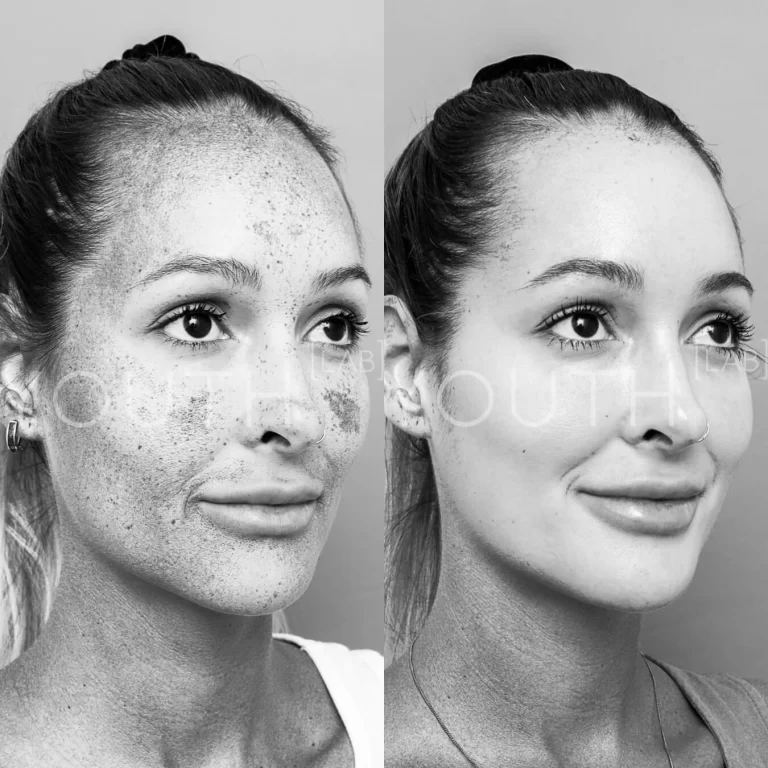 before and after Dermamelan Depigmentation peel with grey filter