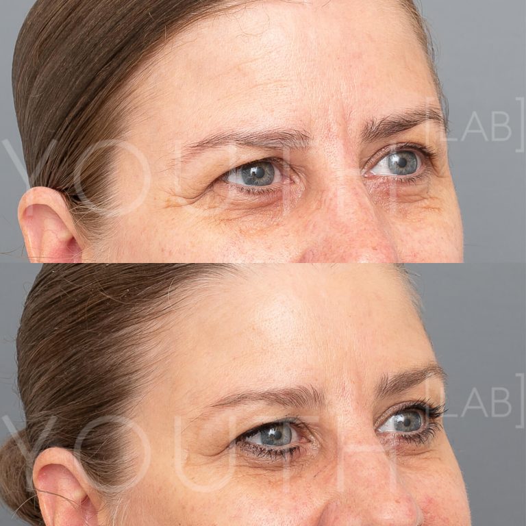 aquagold fine touch before and after 1