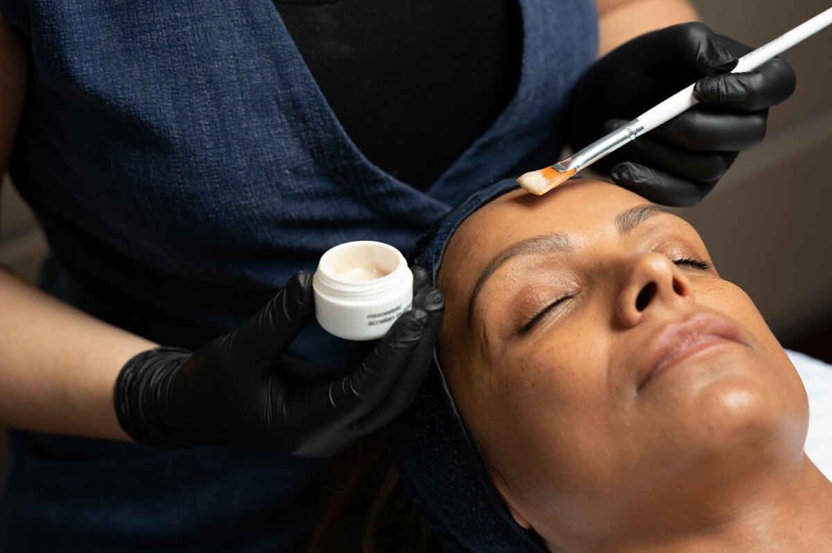 Acnelan Acne Peel Youth Lab, Perth