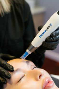 skin needling treatment with dermapen4 close up