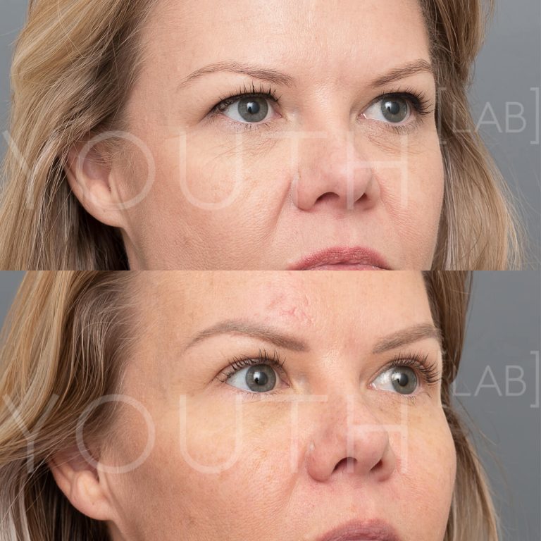 aquagold fine touch before and after
