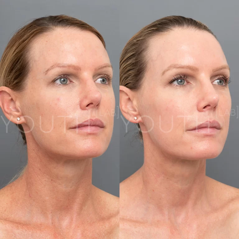 Laser Skin Treatment Perth