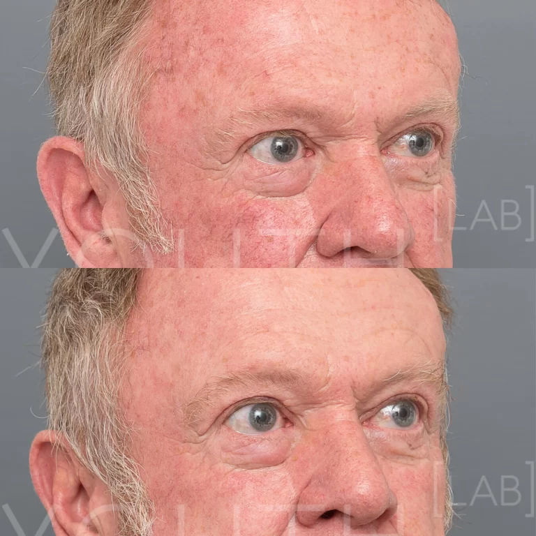 Halo - Hybrid Fractionated Laser before and after redness