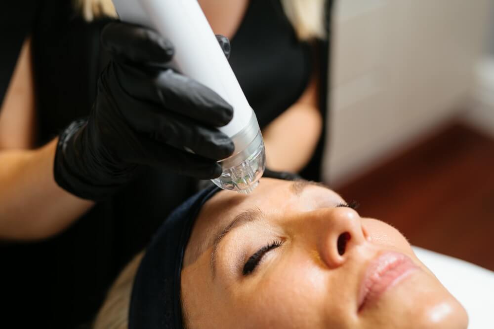 Intensif - RF Microneedling - Youth Lab, Perth