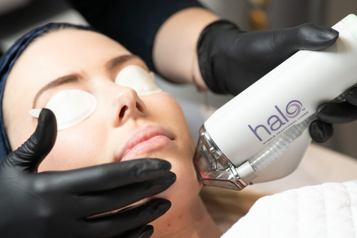 Close up of specialist performing Halo Fractionated Laser on a client at Youth Lab