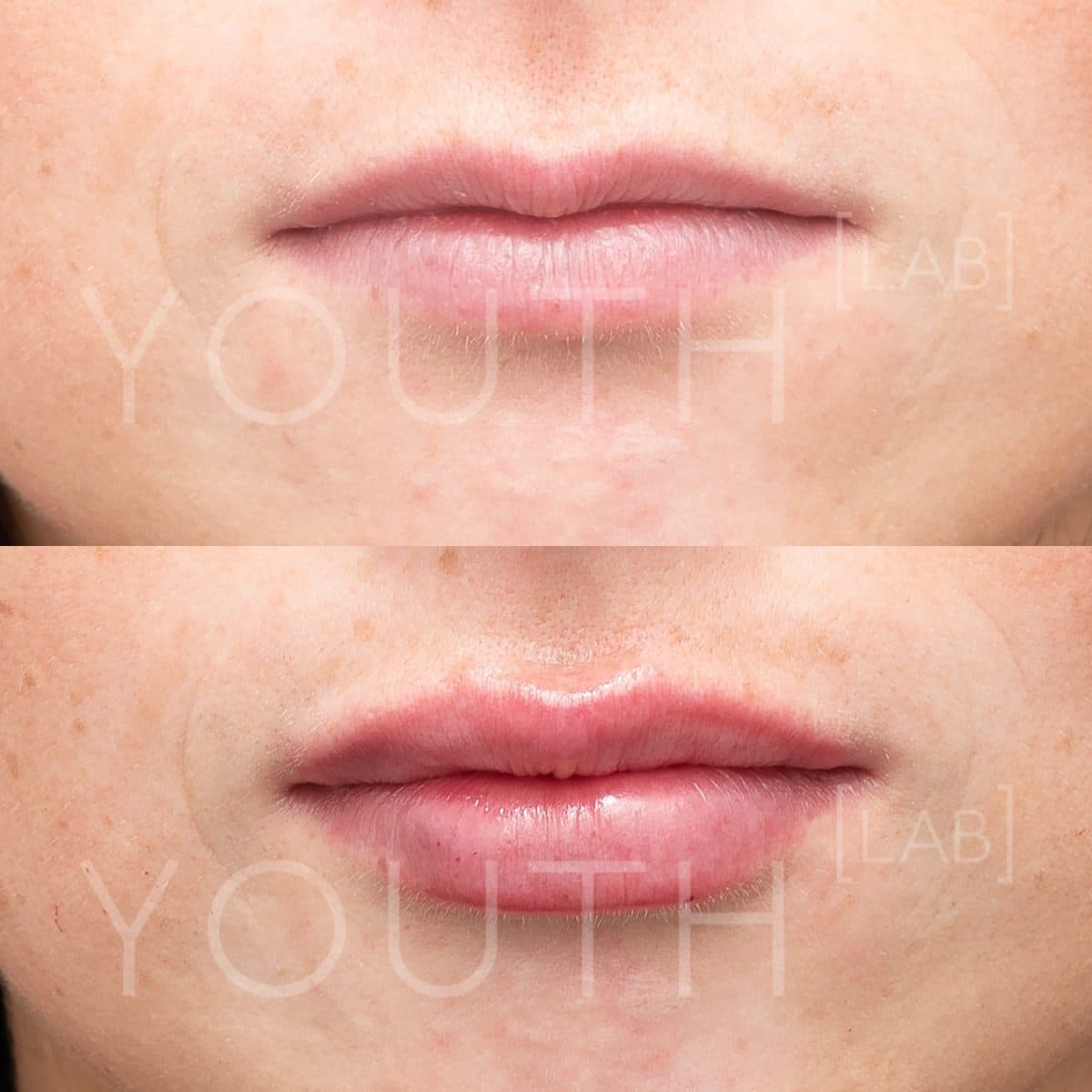 Lip Fillers Must Read Guide Youth Lab