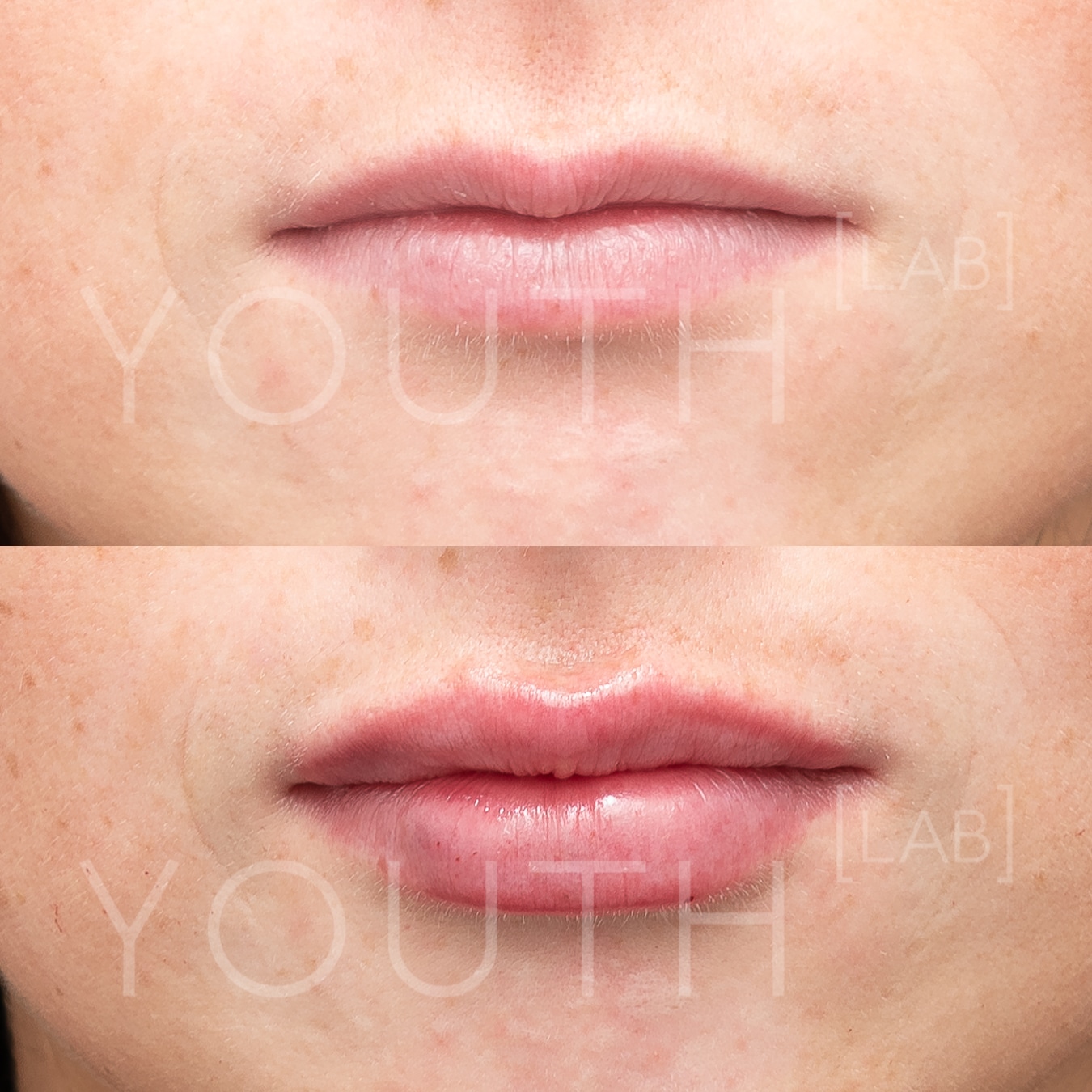 Before and after images of lip filler treatment at Youth Lab