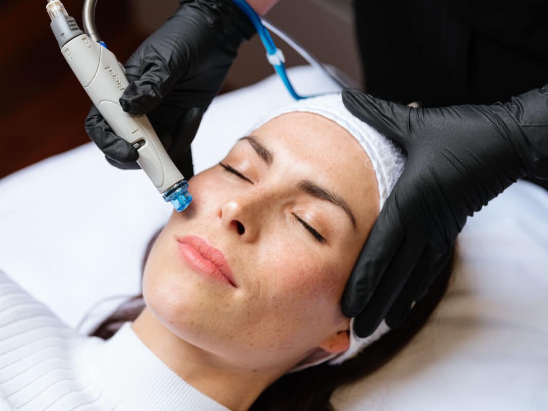 Hydrafacial being performed