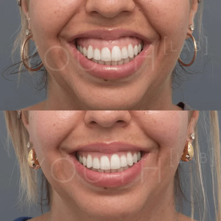 Before and after photo of a botox treatment in Perth