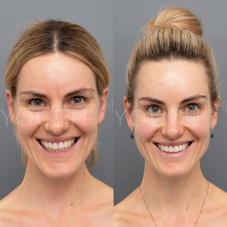 Before & after of Botox treatment in Perth