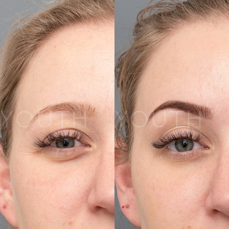 Before and after anti wrinkle injections