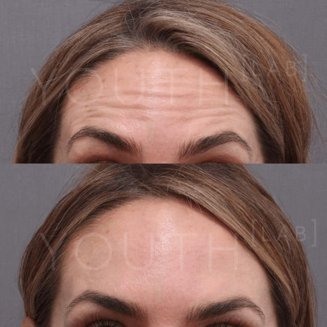 Botox in the forehead of a Perth woman.