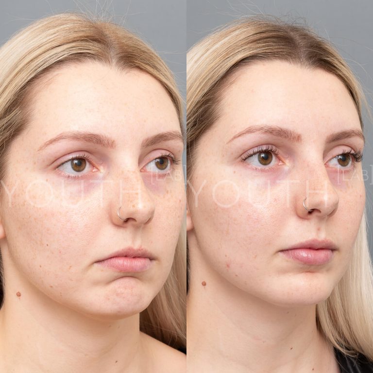 Before and after of botox treatment in Perth