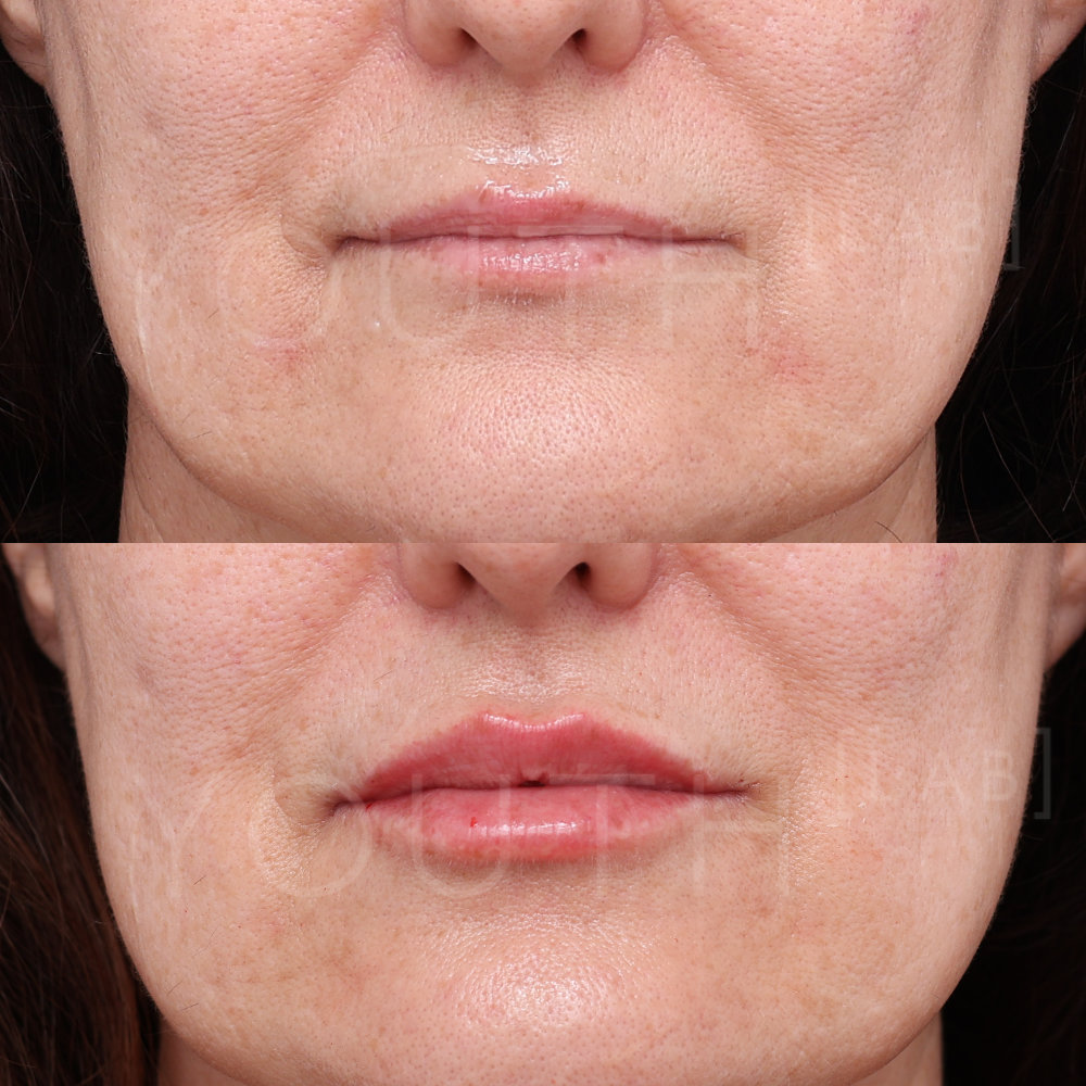 Before and after images of lip filler treatment at Youth Lab
