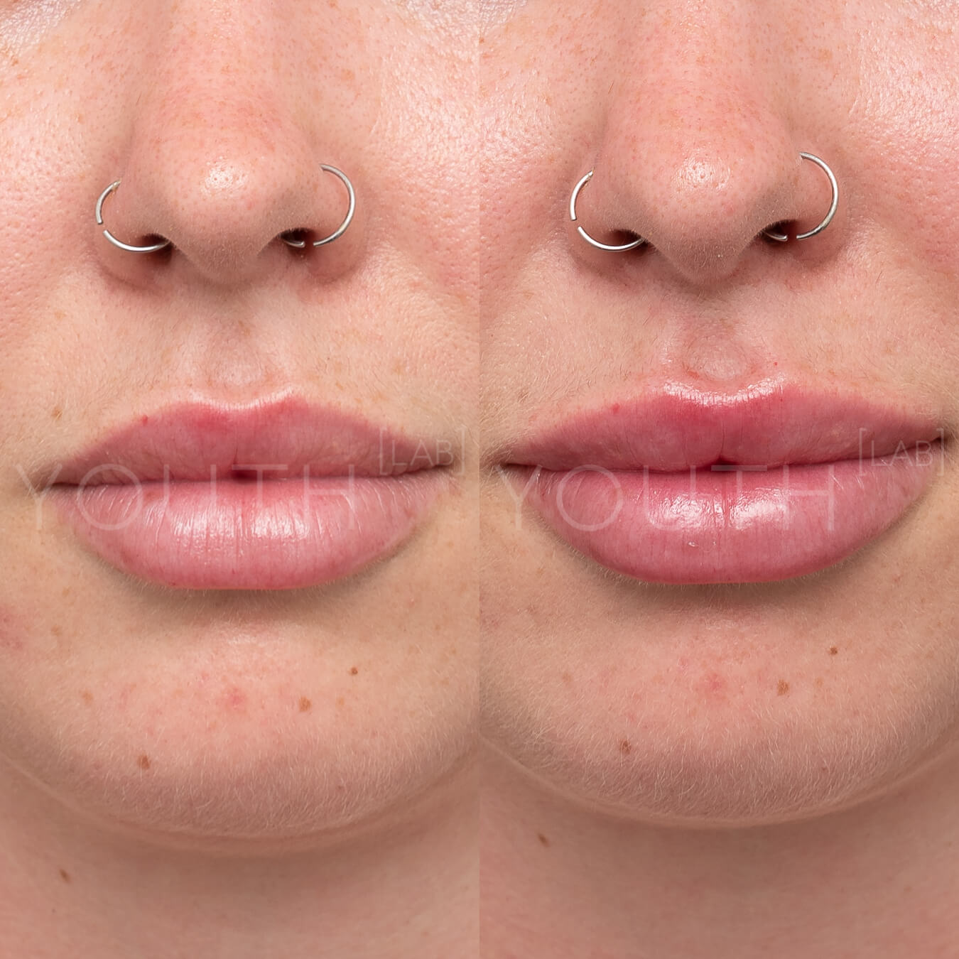 Lip Fillers Natural Results Youth Lab West Perth