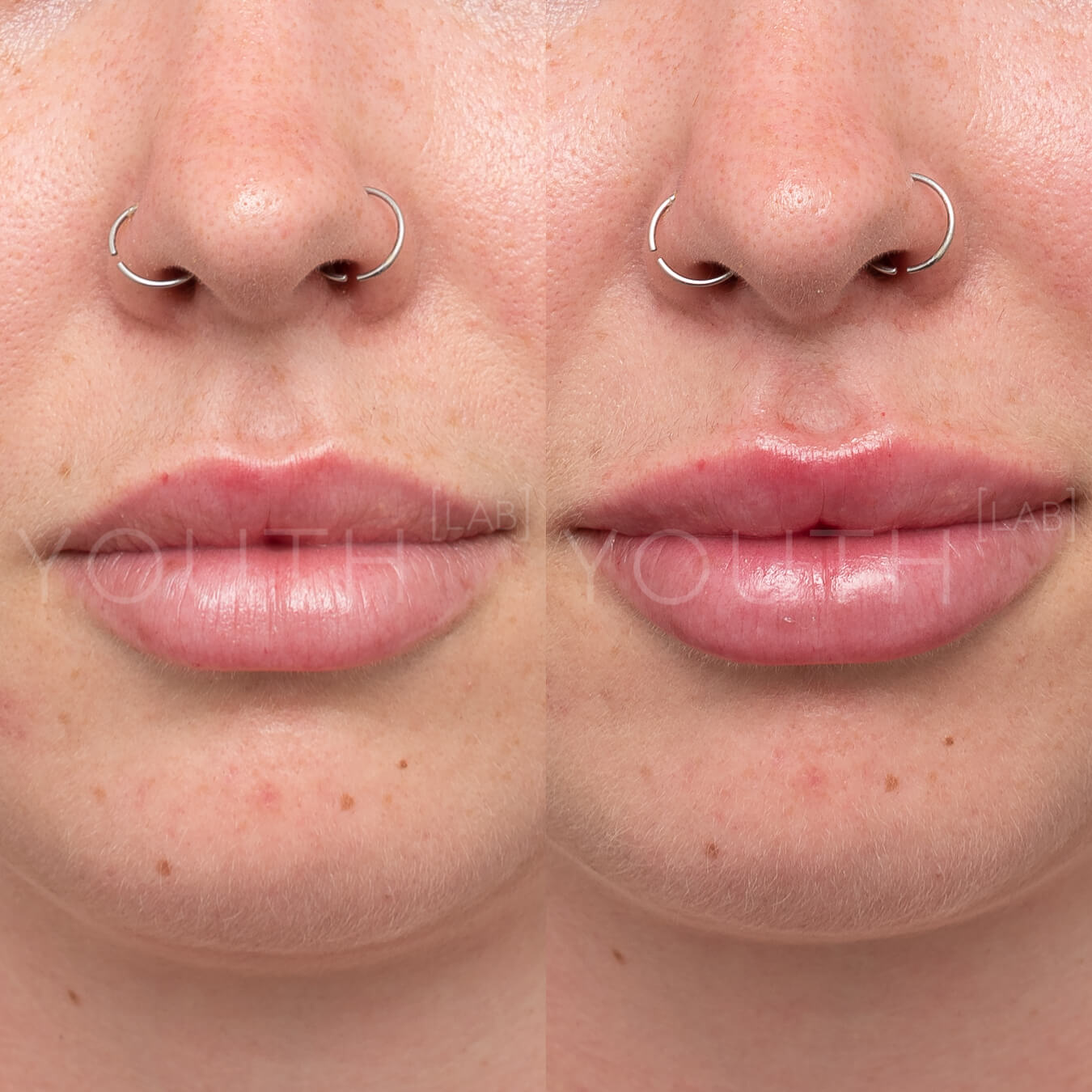 Lip Fillers Natural Results Youth Lab West Perth 